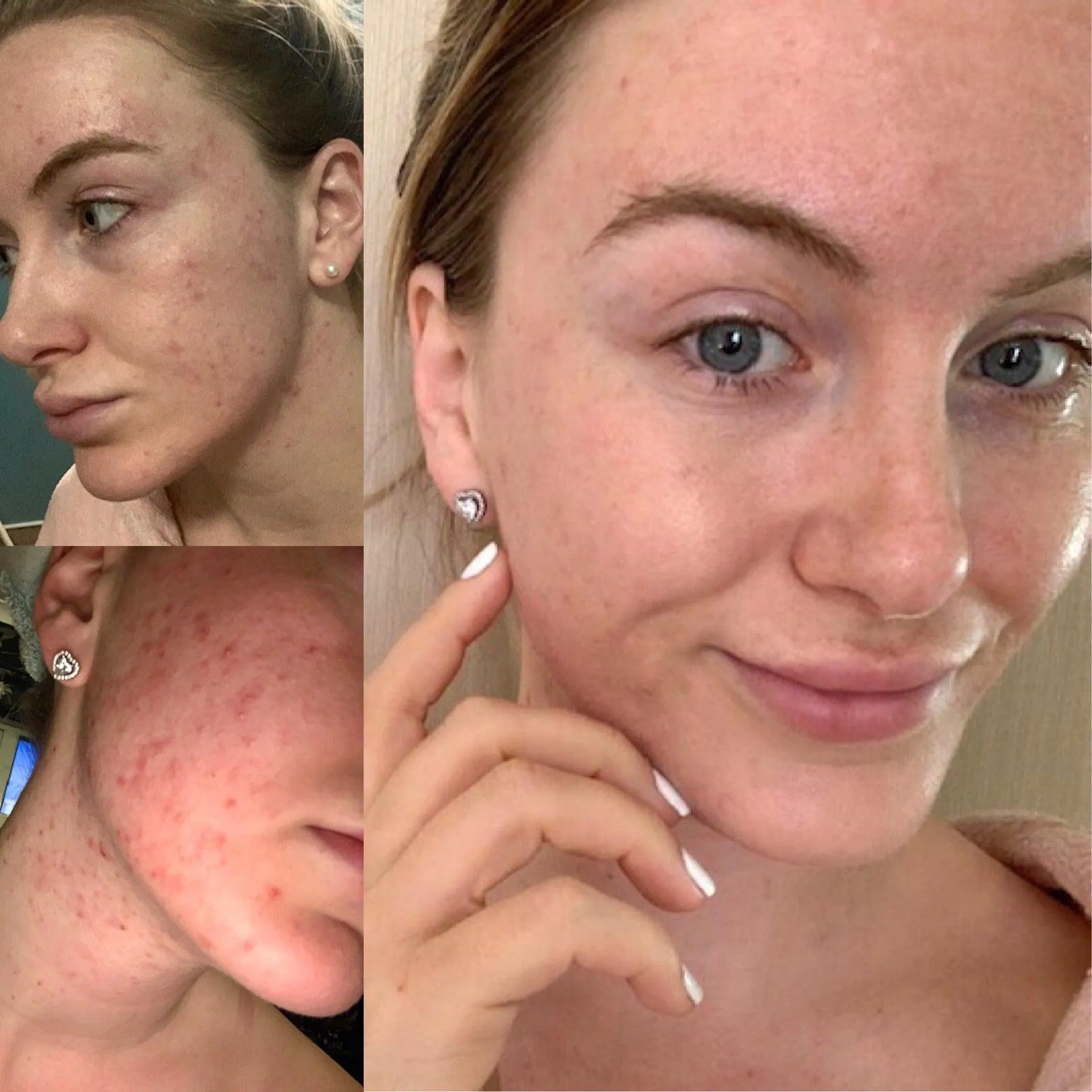 Douvall's Skin-High Acne Rehab Serum