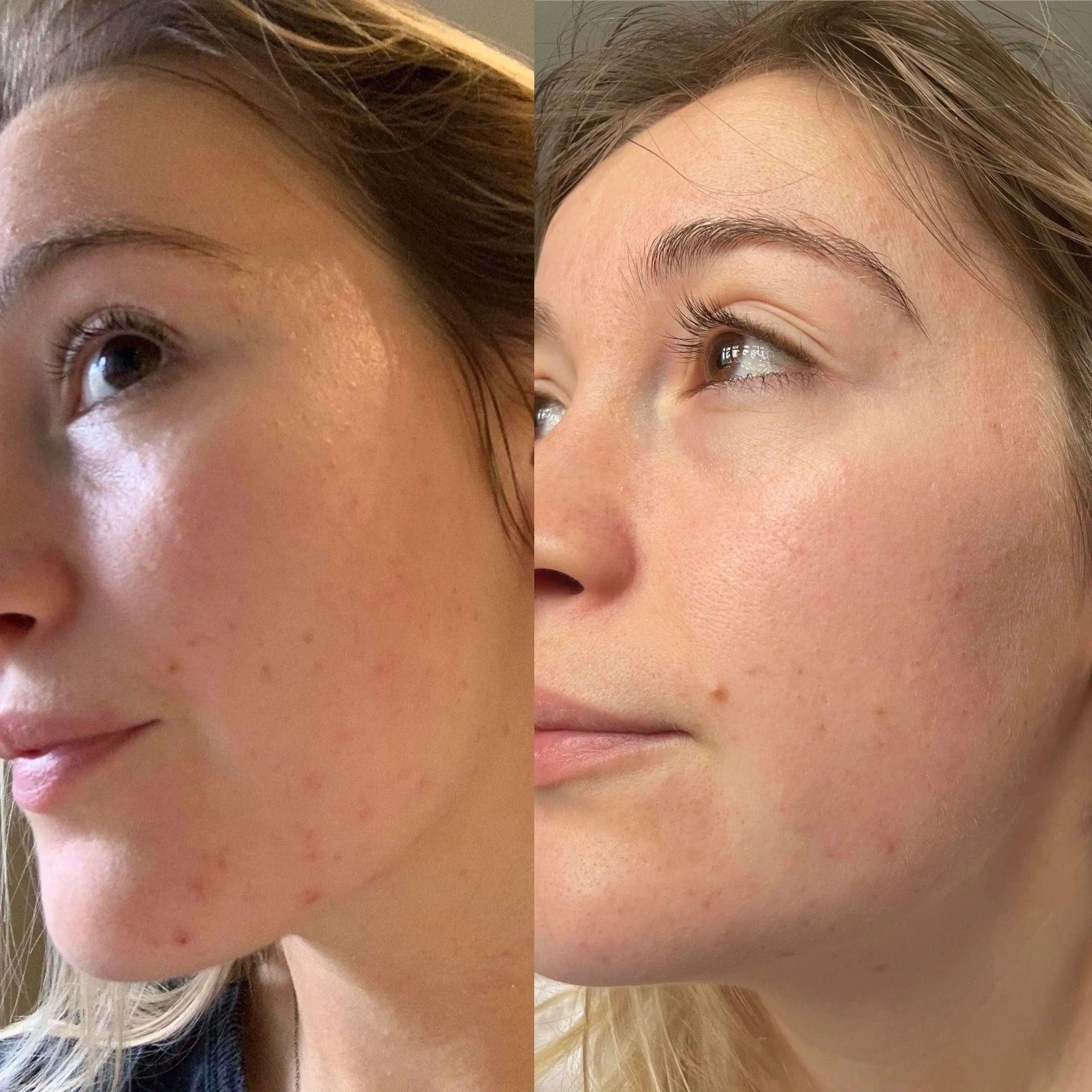 Douvall's Skin-High Acne Rehab Serum
