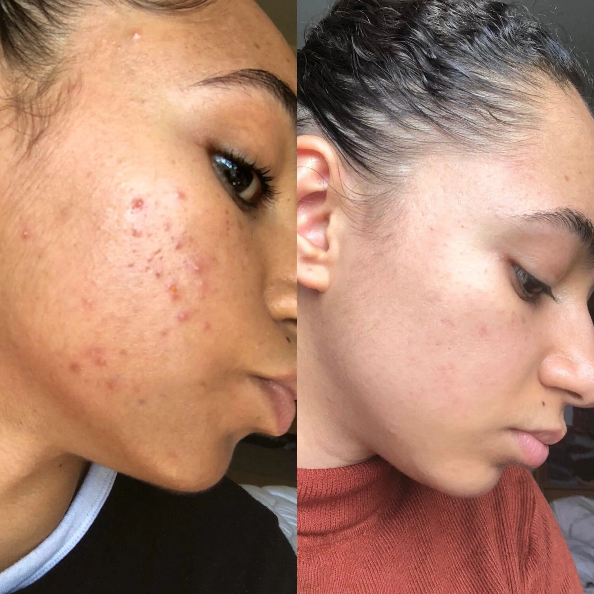 Douvall's Skin-High Acne Rehab Serum