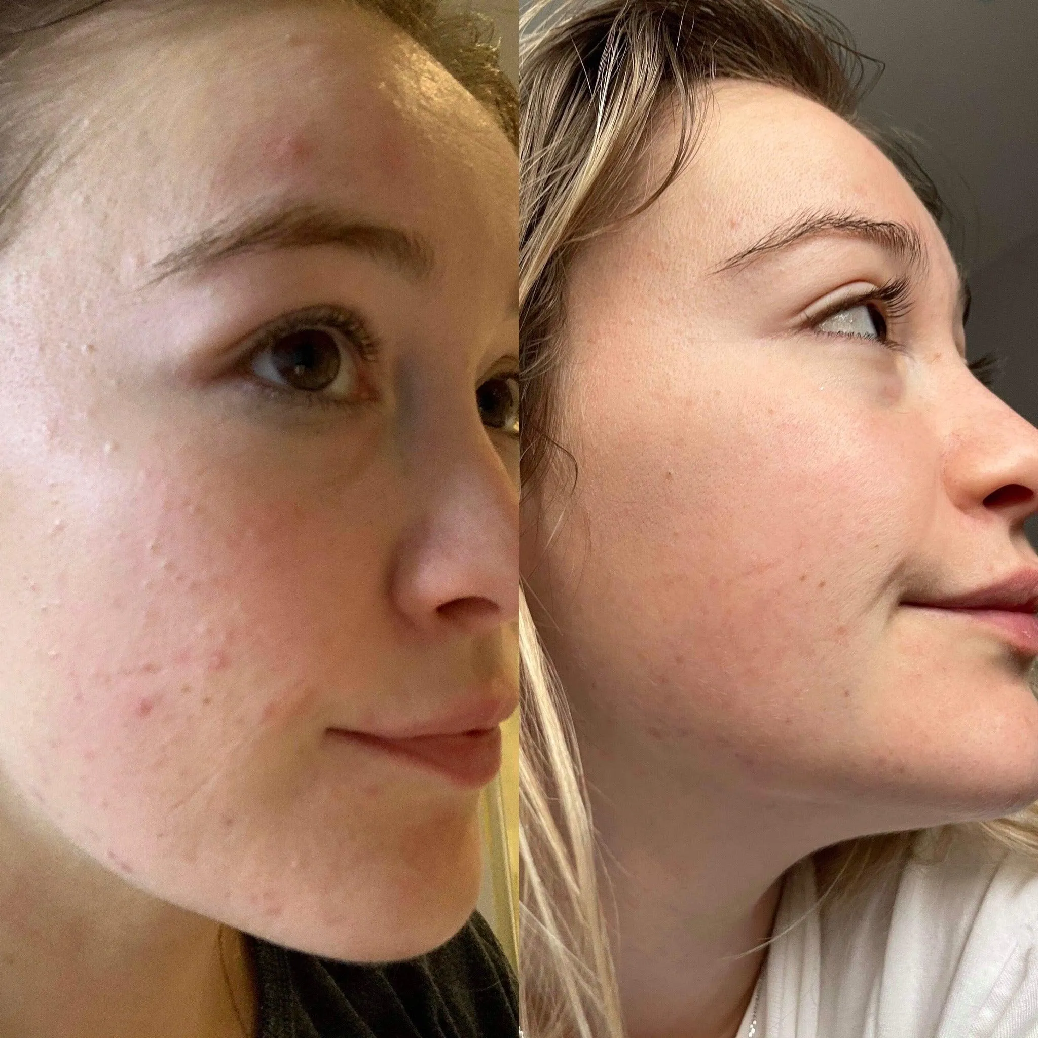 Douvall's Skin-High Acne Rehab Serum