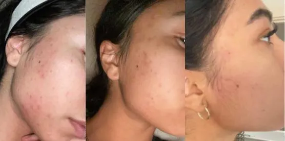 Douvall's Skin-High Acne Rehab Serum